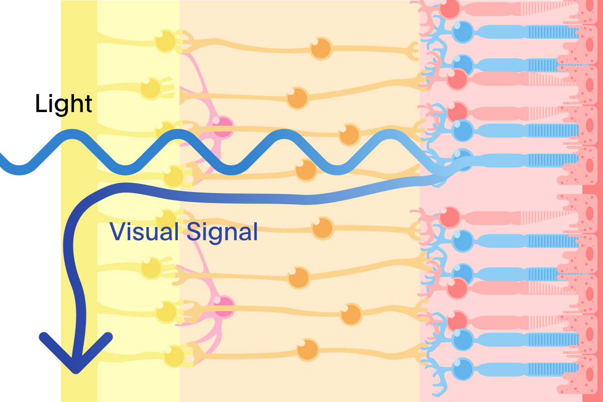 Illustration of a healthy retina showing light entering and traveling through the first two layers of the retina, getting absorbed by the third, and converted into a visual signal.