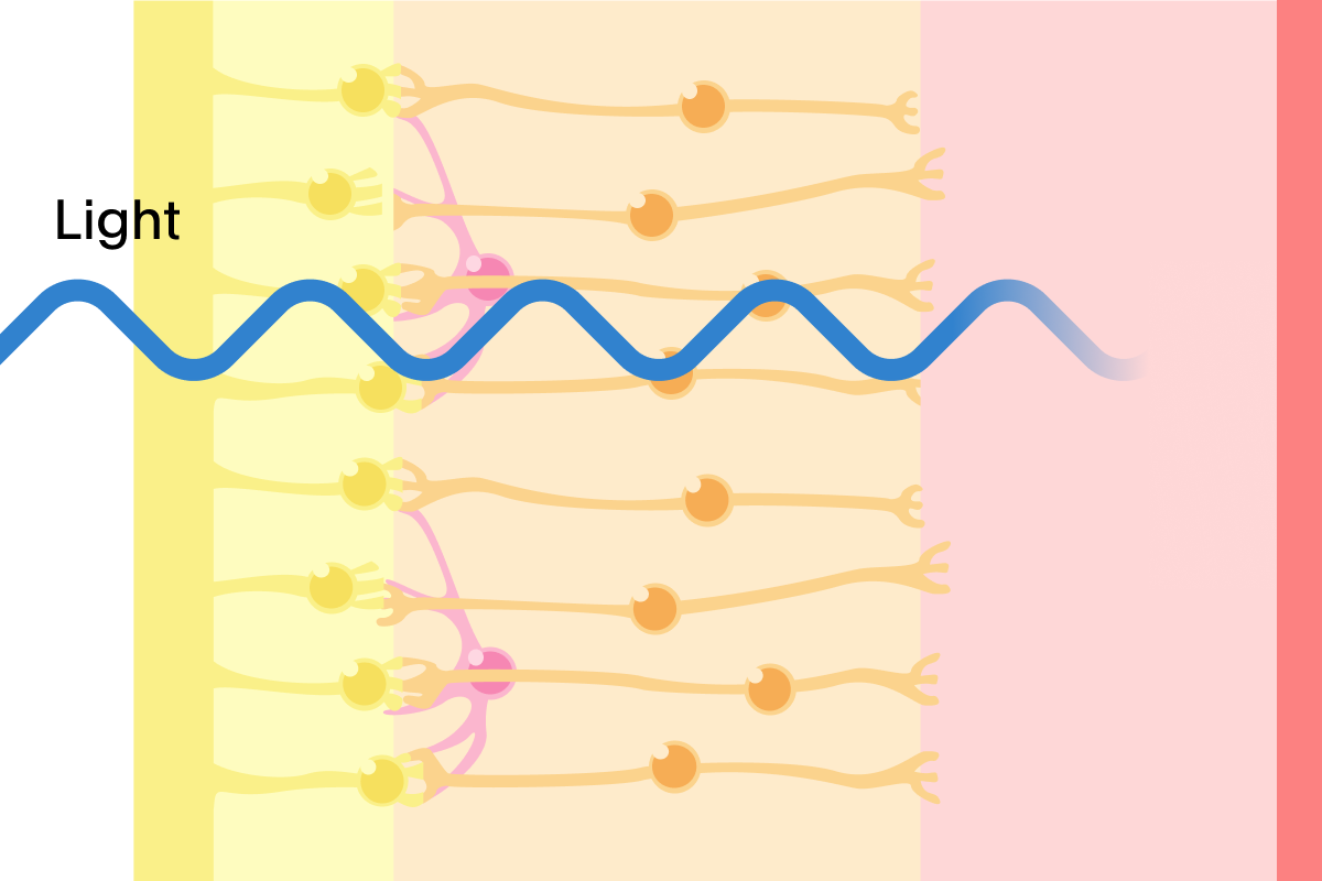 Illustration of a diseased retina showing light entering and traveling through the first two layers of the retina, and not producing any further signal.