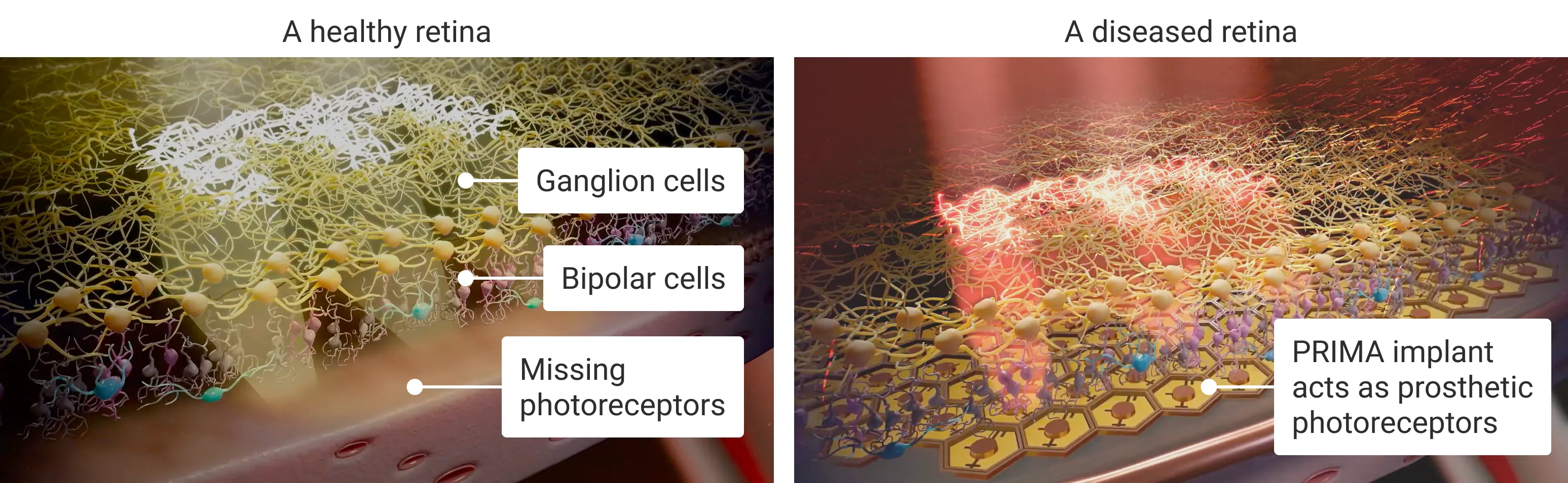 A side by side comparison of the three major layers of cells in a healthy and diseased retina. The diseased retina is missing the photoreceptor layer.