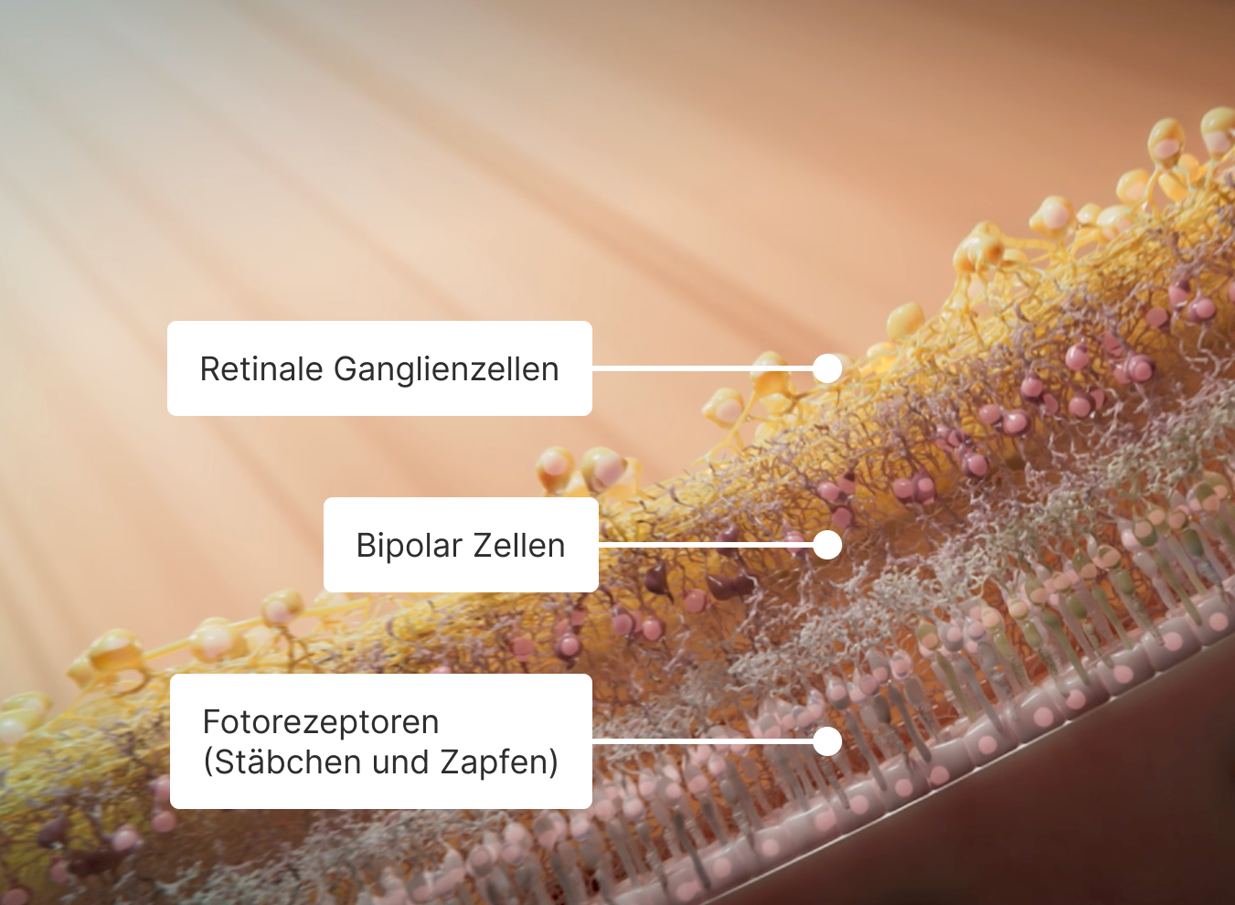 Eine Darstellung der Anatomie einer gesunden Netzhaut, beginnend mit den Ganglienzellen der Netzhaut, dann den Bipolarzellen und schließlich den Photorezeptoren (Stäbchen und Zapfen).