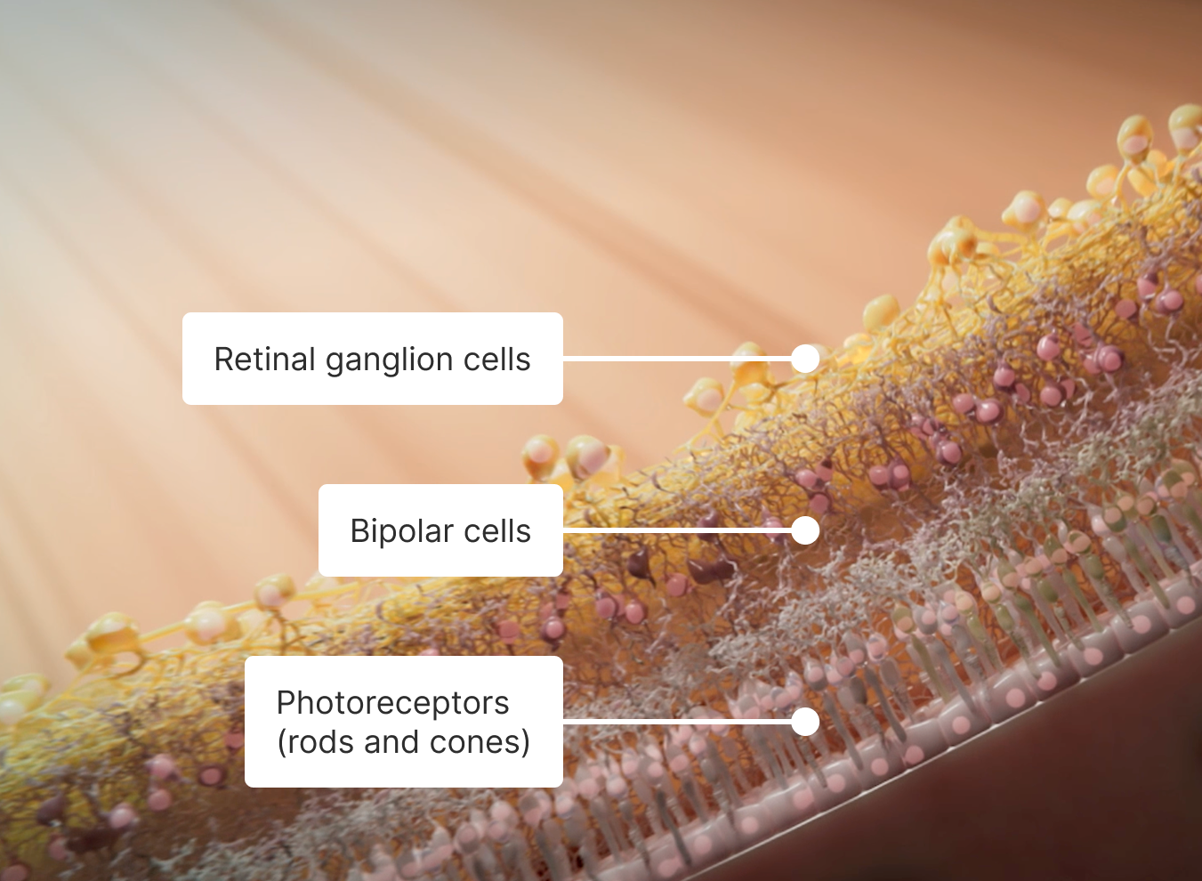 An illustration of the anatomy of a healthy retina, starting with the retinal ganglion cells, then bipolar cells, and finally photoreceptors (rods & cones).