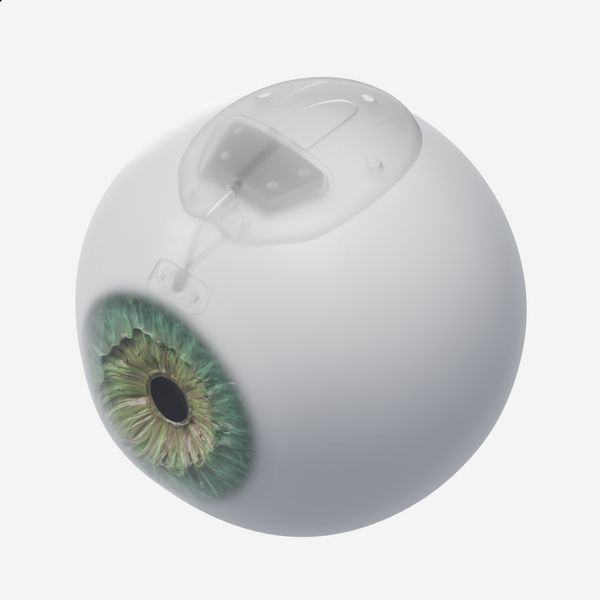 A render of an Ahmed glaucoma valve on the outside of an eyeball, for size comparison