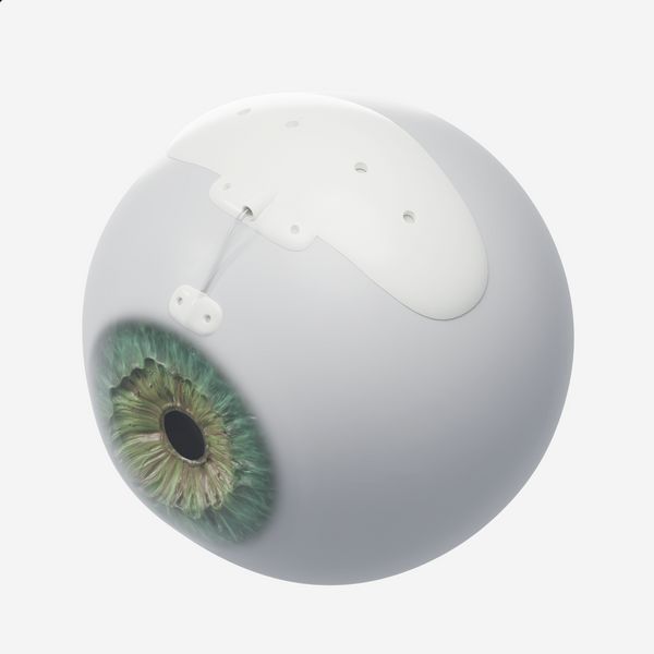 A render of a Baerveldt glaucoma shunt on the outside of an eyeball, for size comparison