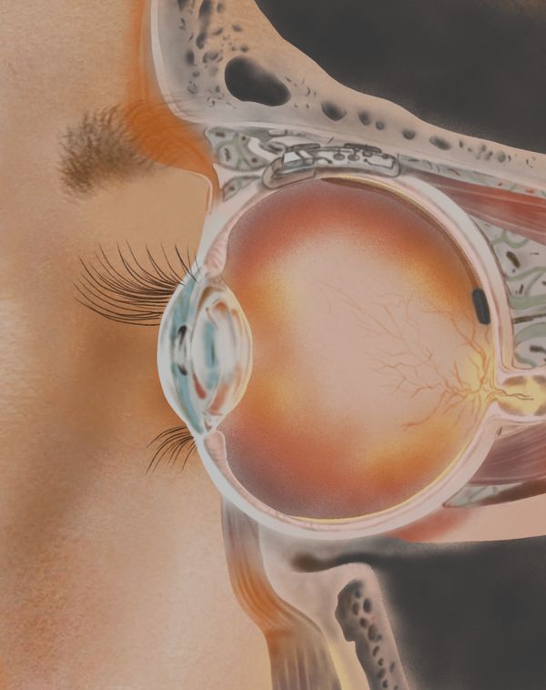 A medical diagram of parts of the eye and optic nerve